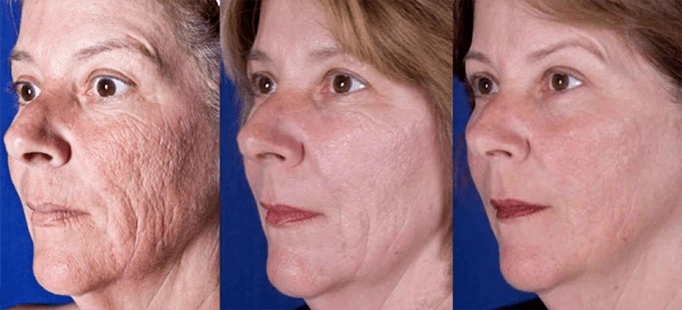 لیزر چہرے کی جلد کی بحالی کے طریقہ کار کے بعد نتیجہ اخذ کریں