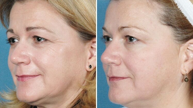 ہارڈ ویئر کی جلد کو پھر سے جوان کرنے سے پہلے اور بعد کی تصاویر