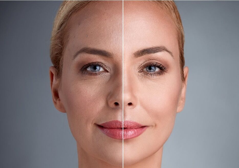 لیزر چہرے کی تجدید سے پہلے اور بعد میں