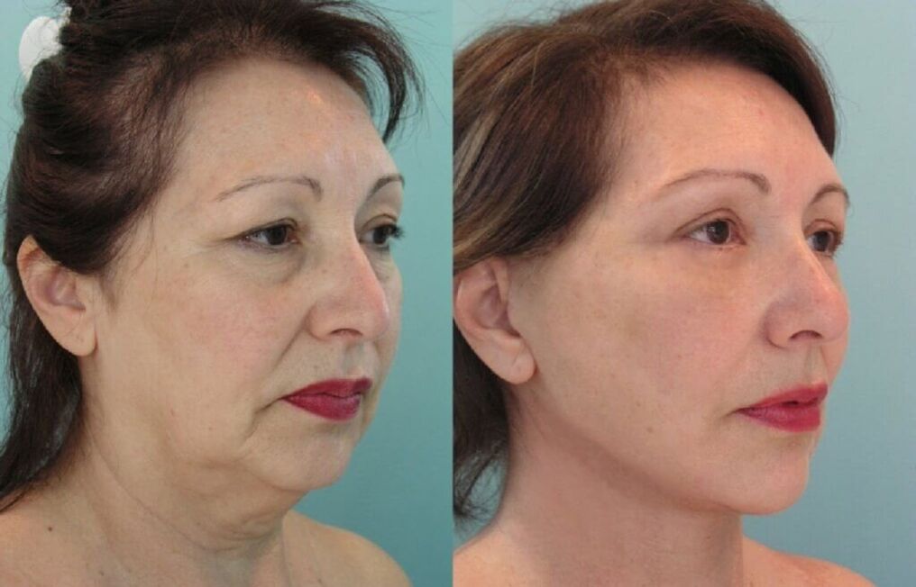 جلد کی تجدید سے پہلے اور بعد کی تصویر